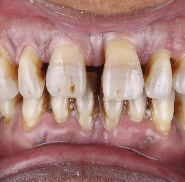 Mandíbula que necesita realizarse un tratamiento periodontal básico