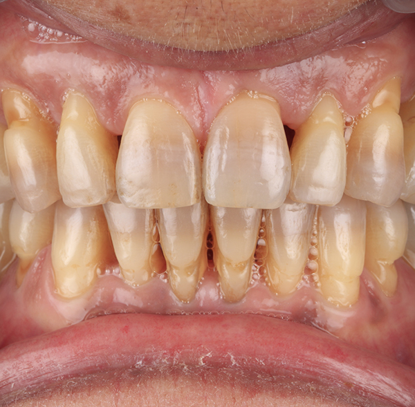 Acabado de una mandíbula tras el tratamiento de periodoncia básico