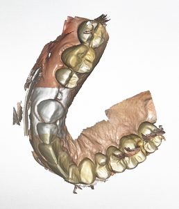 Escáner de una dentadura