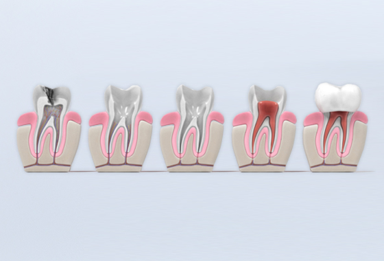 Procedimiento de una endodoncia